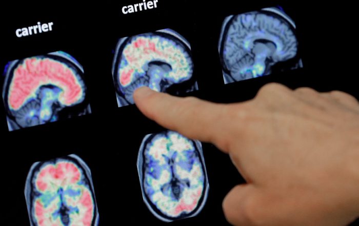An Alzheimer’s Treatment Fails: ‘We Don’t Have Anything Now’