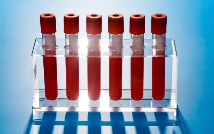 What Does a Coronavirus Antibody Test Actually Tell You?