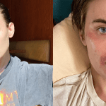 Tallulah Willis, an ‘Antsy-Handed Chronic Picker,’ Shared New Skin Transformation Photos