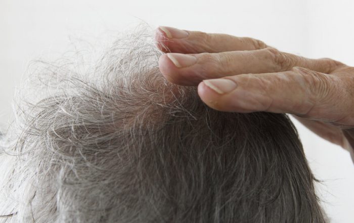 Losing Your Hair? You Might Blame the Great Stem Cell Escape.