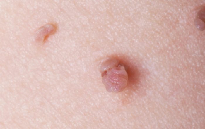Here’s How to Get Rid of Skin Tags Without Hurting Yourself