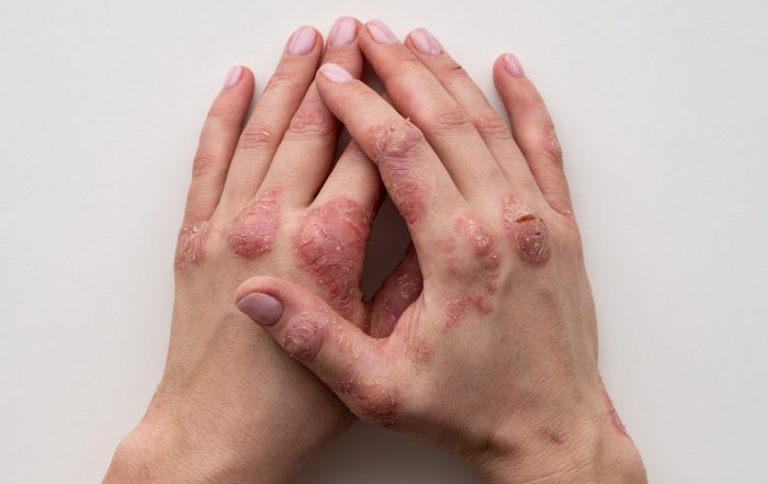 Psoriasis Vs. Eczema: How to Tell Them Apart