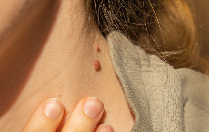 The FDA Has Cracked Down on Amazon for Selling Unapproved Skin Tag Removal Products
